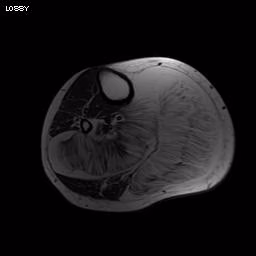 Angiolipoma MRI0002