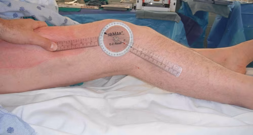Multiple Osteochondromas