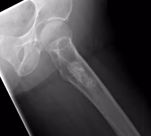 Chondrosarcoma Proximal Femur Xray0002