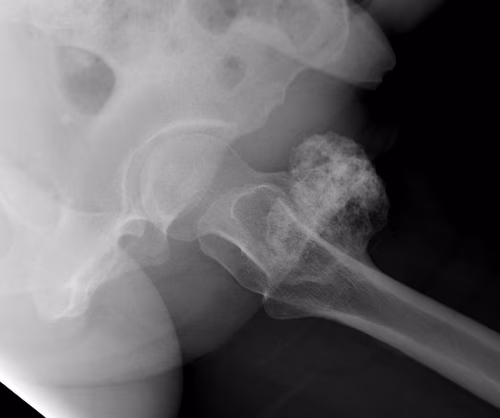 Proximal Femur Bony Tumour0002