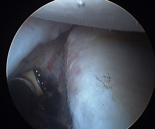 Shoulder Stabilisation Anterior Labral Mobilisation 2