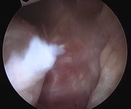 Capsular Tear 2