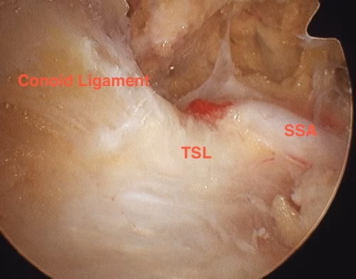 Suprascapular artery and transverse scapula ligament