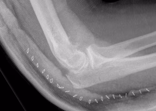 Elbow OK Procedure Lateral