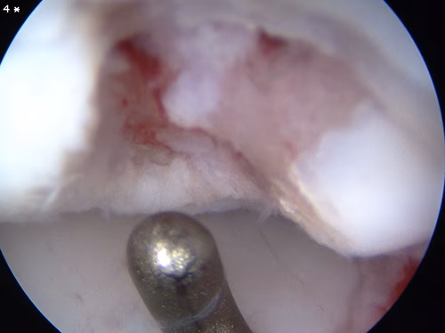 Elbow Scope OCD