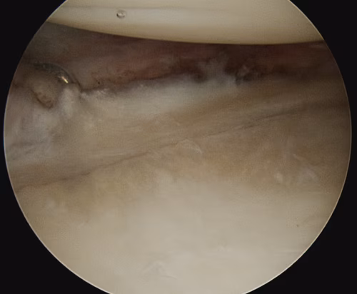 Frozen Shoulder Posterior Capsule Release