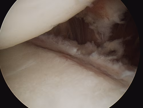 Frozen Shoulder Posterior Release Complete