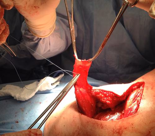 LDTT tendon suture