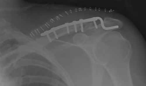Lateral Clavicle Fracture Hook Plate Post op