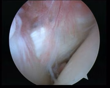 Arthroscopy Normal Subscapularis