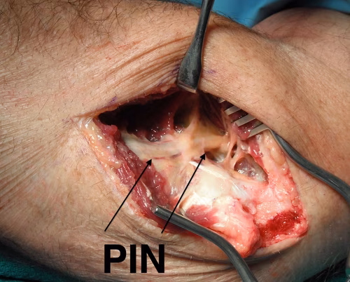 PIN in radial tunnel release
