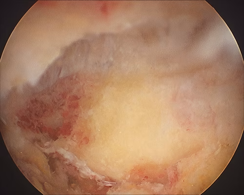 Post Arthroscopic ACJ resection