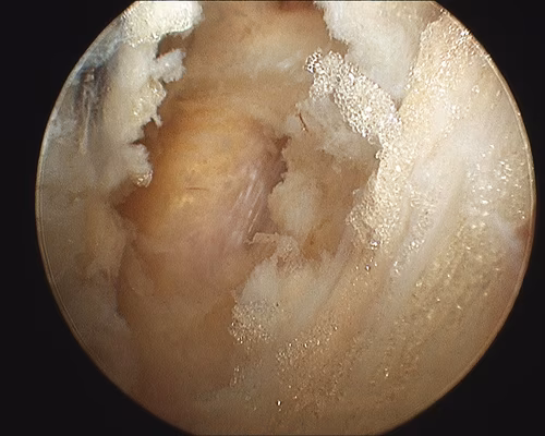 SSN Release Coracoid
