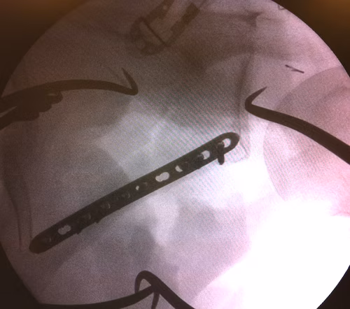 Scapula ORIF