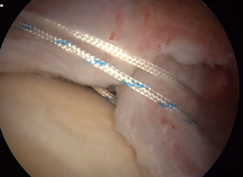 Arthroscopic Cuff Repair Margin Convergance 1
