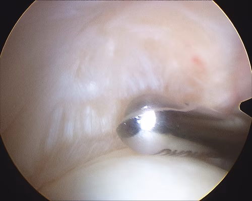 Shoulder Scope PASTA Debridement