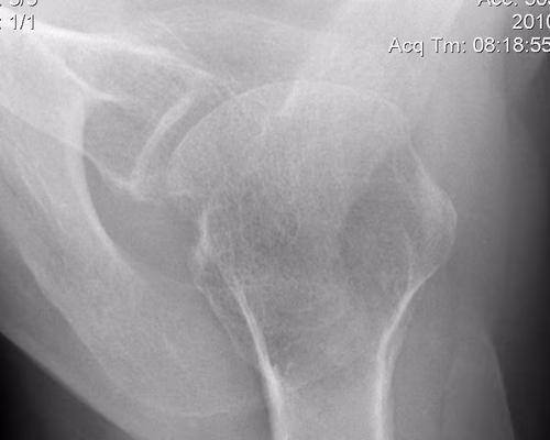 Shoulder Hill Sachs Axillary Lateral