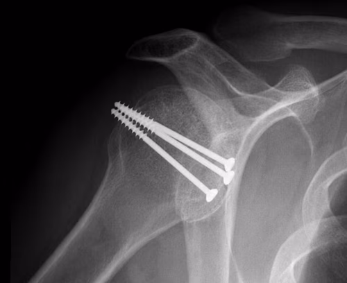 Shoulder McLaughlin Lateral