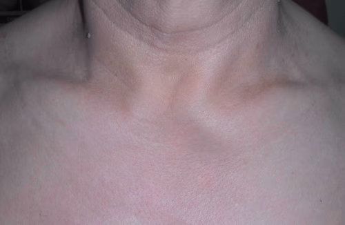 Sternoclavicular OA