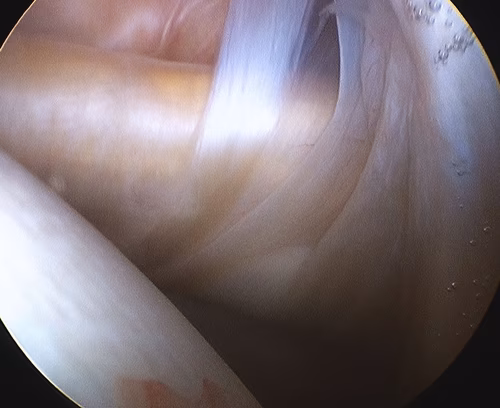 Subscapularis Normal Arthroscopy