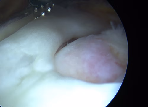 Supraspinatous Tear Crescent Shaped