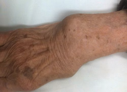 RA Wrist Caput Ulna 2