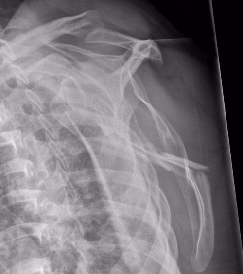 scapula