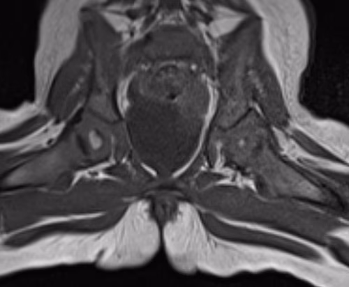 MRI