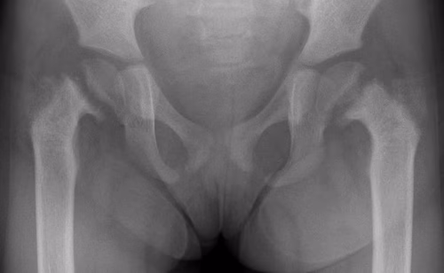 Rickets hips