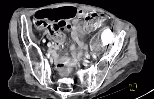 Intra-pelvic revision