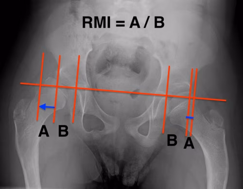 RMI