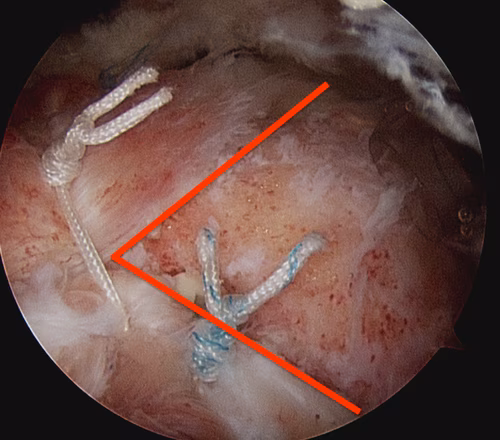 partial repair