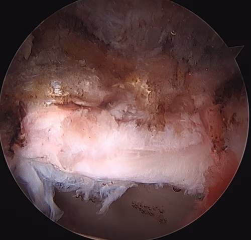 Labral repair