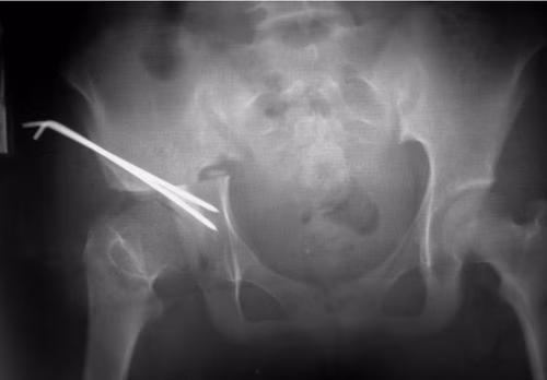 Chiari