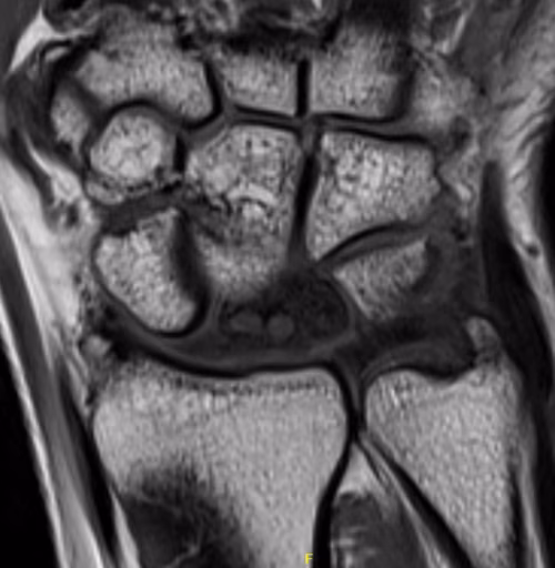 MRI kien