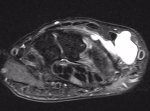 ganglion