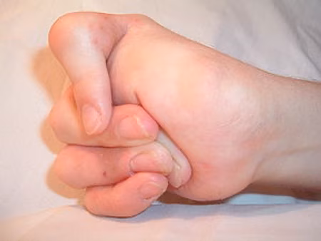 arthrogryposis