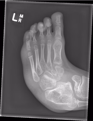 arthrogryposis
