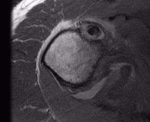 MRI tendinopathy