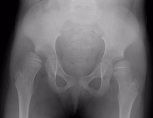 CP hip