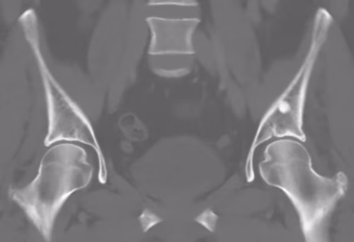 CT bone island