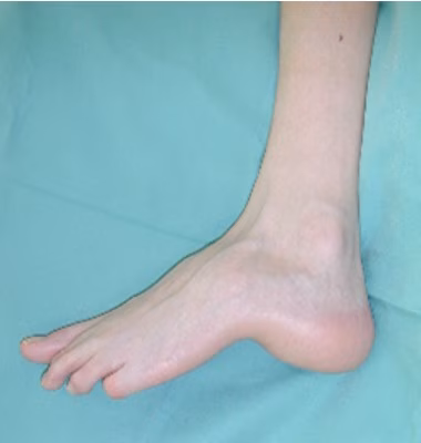 calcaneocavus