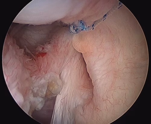 Capsular repair