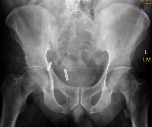 Sacral chordoma