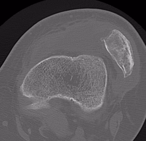 patella