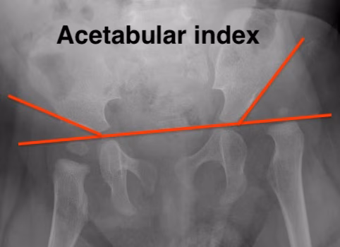Acetabular index
