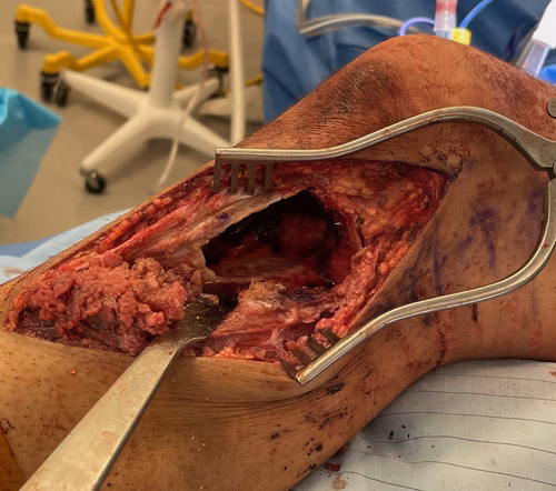 Giant cell tumour