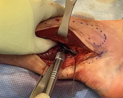 Posterolateral