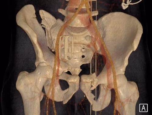 Vert shear CT