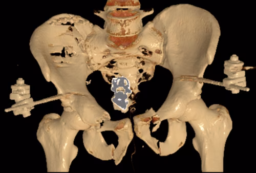 Vert shear inital management